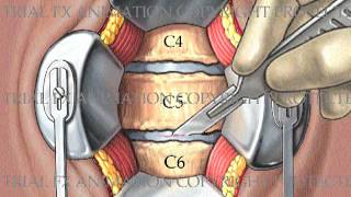 2 Level Cervical Arthrodesis with ProDiscC [upl. by Euqimod]