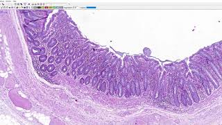 SWU Pathology Talk lab GI pathology Colonic diverticulosis [upl. by Newmark129]