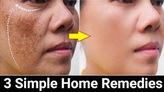 Remove Face Pigmentation Naturally [upl. by Yr]