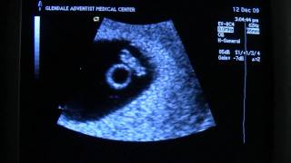 Ultrasound 6 weeks 6 days  Heartbeat [upl. by Reyaht]