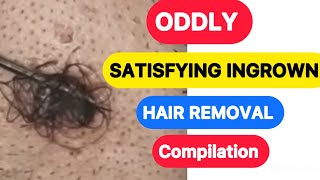 Satisfying Ingrown Hair Compilation Video  Oddly Satisfying ingrown Hair [upl. by Musser]