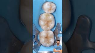 Composite restorationحشو تجميلي shortvideo shortsviralshorts [upl. by Rochelle]