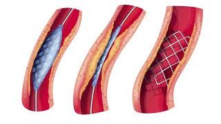 Enfermedad arterial periférica síntomas y tratamiento │Unique Interventional Radiology [upl. by Selassie]