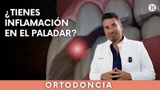 ¿Tienes INFLAMACIÓN en el PALADAR superior [upl. by Beitnes132]