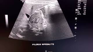 Ultrasound cases POSITIVE Hypertrophic Pyloric Stenosis  pediatric sonography [upl. by Necaj]