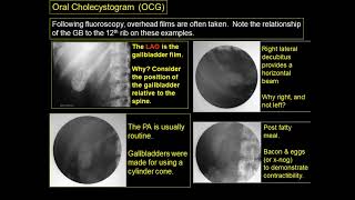 Radiography of the biliary system [upl. by Naujej655]