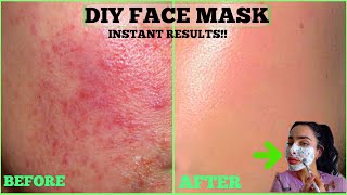 DIY FACE MASK for Sensitive Skin  How To Get Rid of Pimples  Acne Scars FAST Natural Home Remedy [upl. by Eanehs]