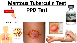 Mantoux Test  Tuberculin Skin Test  PPD Test  Purified protein derivative [upl. by Naaitsirhc]