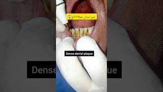 ازالة وتنظيف جير الاسنان ازالة بلاكوالاسنات والقلح dentist stitch اكسبلور stitchlover ترند [upl. by Nay573]