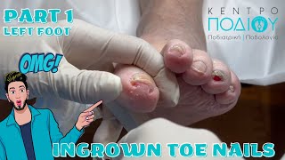 Ingrown ToenailΕίσφρυση όνυχος callus κεντροποδιου footcare podologos podiatrist podiatry [upl. by Ransom]