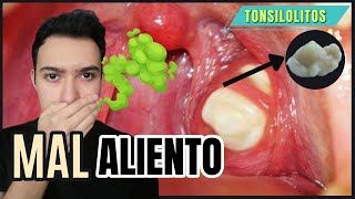 TONSILOLITOS mal aliento COMO QUITARLO  Tonsilolitos como ELIMINAR  BOLITAS BLANCAS en garganta 😭👈 [upl. by Vada]