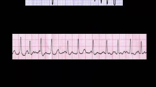 CURSO DE ELECTROCARDIOGRAFIA 24  AUTOEVALUACIÓN SOBRE MEDICIÓN DE FRECUENCIA [upl. by Eartnoed67]