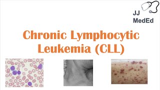 Chronic Lymphocytic Leukemia CLL Symptoms ex Skin Blisters Diagnosis and Treatment Vit D [upl. by Nellahs]