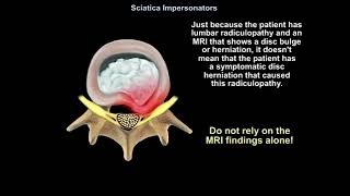 Sciatica Impersonators Explained Top Causes Symptoms and Treatments You Must Know [upl. by Leaffar]