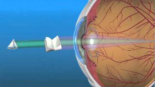 Multifocal Lens IOL [upl. by Learsi]