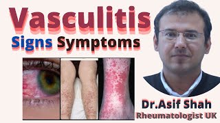 Vasculitis Signs Symptoms  Basic Understanding for Common public  Urdu Hindi [upl. by Bernat]