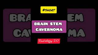 MRI BRAIN 🧠 BRAIN STEM CAVERNOMA  SHORT [upl. by Airelav]