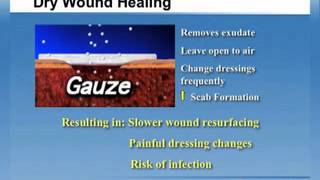 Why Moist Wound Healing [upl. by Salena]