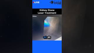 Kidney stone laser treatment  RIRS  Retrograde Intrarenal Surgery  shorts [upl. by Abigale181]