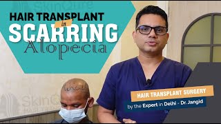 Hair Transplant in Scaring Alopecia  Best Hair Transplant Clinic in Delhi [upl. by Huttan]