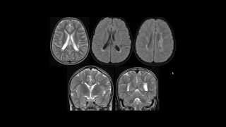 Leucomalácia periventricular [upl. by Nerag675]