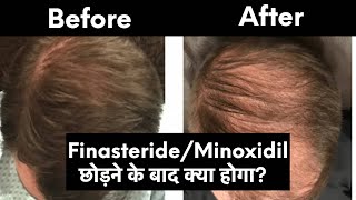 FinasterideMinoxidil कब तक लेनी पड़ेगी भूलकर भी ये गलती न करें [upl. by Cima]