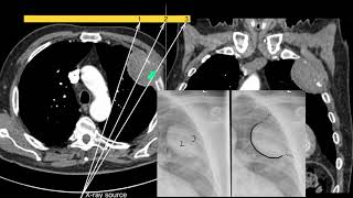 Radiology Rounds 026 Anterior Mediastinal Masses Differential Diagnosis [upl. by Mond424]