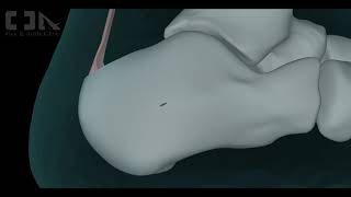 MinimallyInvasive Haglunds Deformity Surgery [upl. by Eamanna]