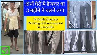 tibia fibula femur multiple fracture recovery in 3 months walking ACLLigamentFractureIlizarov [upl. by Anibur]