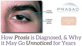 How Eyelid Ptosis is Defined by Measuring the Eyelids in Relation to the Iris and Pupil [upl. by Aluor]