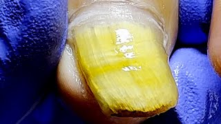 Professional Trimming Of Onychomycosis Full Of Scum【Podiatry Clinic】 [upl. by Quenby]