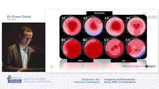 LéchocardiographieetlamyloseErwanDonalMACAmyloidosis [upl. by Yelsew574]