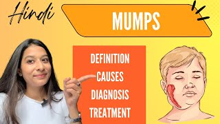 Mumps  Symptoms diagnosis Treatment  Explained easily in Hindi [upl. by Plate]