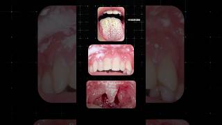 வாயில் ஏற்படும் பூஞ்சை தொற்று Oral Thrush Dr Isacc Abbas [upl. by Yeca]