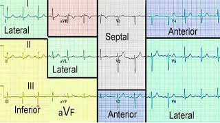 Infarto Agudo del Miocardio con Elevación del Segmento ST [upl. by Dove]