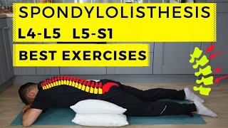 Anterolisthesis l5 s1 treatment spondylolisthesis l4l5 lumbar spine grade 1 in hindi Dr nayan [upl. by Nytsirt171]