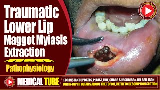 Traumatic Lower Lip Maggot Myiasis Extraction  Pathophysiology 2024  InDepth Analysis [upl. by Modestine]