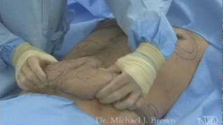 Liposuction of stomach area on a man [upl. by Eudora]