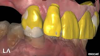 Smile Creator and Digital Waxup in EXOCAD Case 3 [upl. by Leifer]