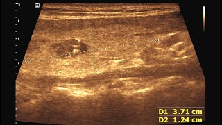 Thyroid Gland Nodule  Colloid Cyst [upl. by Winebaum]