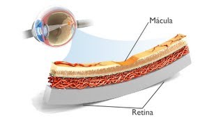 La Degeneración Macular Asociada a la Edad DMAE ANIMACIÓN [upl. by Honan]