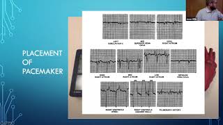 Dr McMahon  quotTransvenous Pacingquot [upl. by Attekahs]