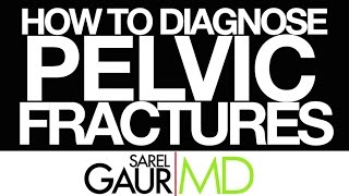 How To Diagnose Pelvic Fractures [upl. by Ruthven]