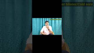 Fever blistersCold sore treatment medicine ointment shorts ytshorts drniteshraj [upl. by Thema]