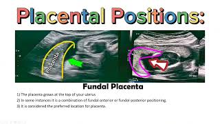 Placenta Positions on Ultrasound  AnteriorPosteriorFundalLateral Placental Positioning USG [upl. by Zeuqcaj753]