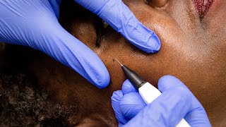 Skin Tags Removal with Electrolysis [upl. by Cooe378]