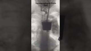 A tracheoesophageal fistula TEF radiology paediatric clinical neetpg [upl. by Hung]