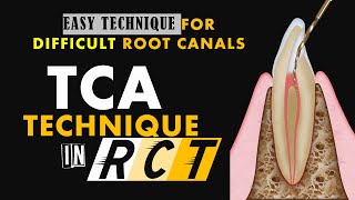 TCA TECHNIQUE  COMPLICATED ROOT CANAL TREATMENT MADE EASY [upl. by Dinsmore]