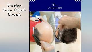 Norwood 7  Saç ekimi sonucu  Hair transplant result Dr  Felipe Pittella  Brazil [upl. by Stanwood838]