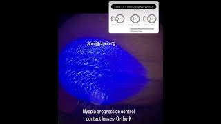 Orthokeratology lens for controlling the myopia progression contactlens orthokeratology [upl. by Ani306]